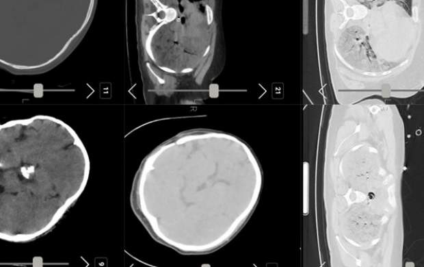 احتمال خون‌ریزی مغزی مهسا امینی منتفی است